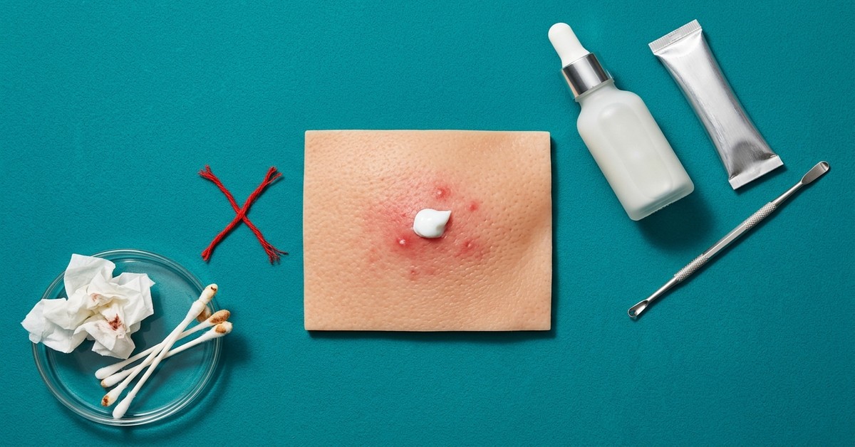 ニキビに歯磨き粉は効果的？その理由と正しい使い方を解説