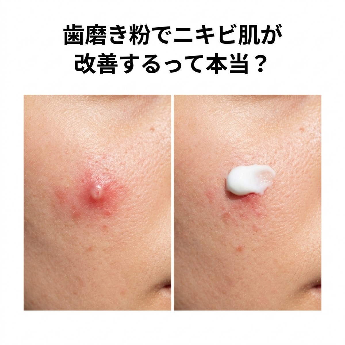 ニキビに歯磨き粉は本当に効果がある？科学的根拠と正しい使い方を徹底解説